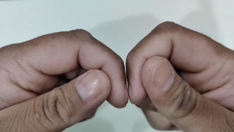Mans fingers with clubbing condition